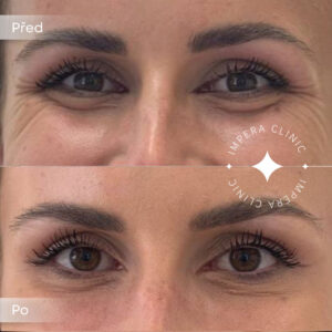 botox