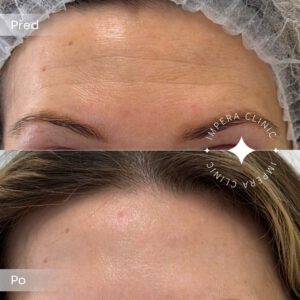 botox (2)