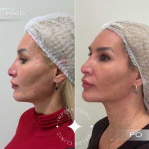 contouring