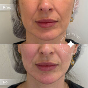 contouring