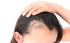 Problém-zvaný-alopecie