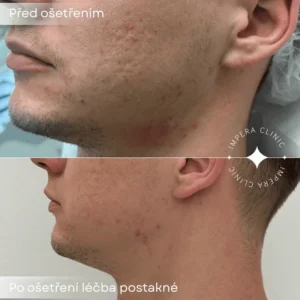 RF-lifting-obličeje