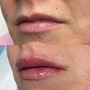 Výplň_rtů_Impera_Beauty