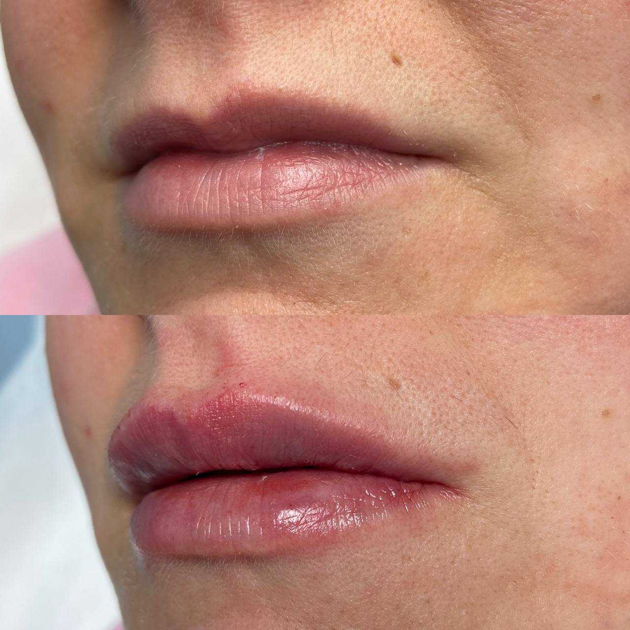 Výplň rtů Impera Clinic Výplň rtů Impera Clinic